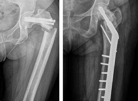 Esquema de fijación estable de fractura de cuello femoral