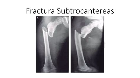 Variantes de placas para fracturas subtrocantéreas