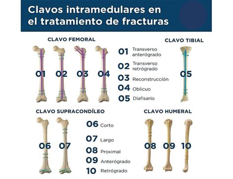Tipos de clavos para fracturas subtrocantéreas