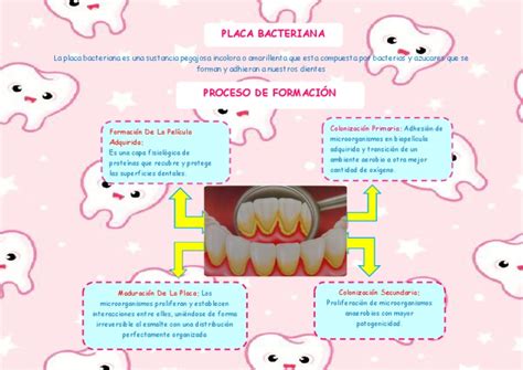 Esquema de la formación de sarro dental a partir de placa bacteriana