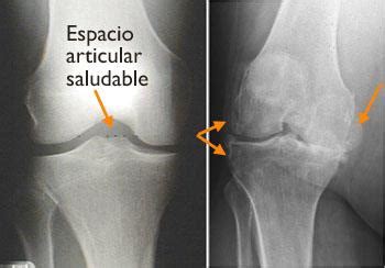 Radiografía de una rodilla con osteoartritis, mostrando reducción del espacio articular y espolones óseos