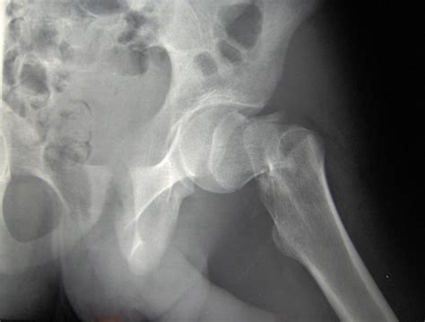 Radiografía de una fractura osteoporótica de cadera