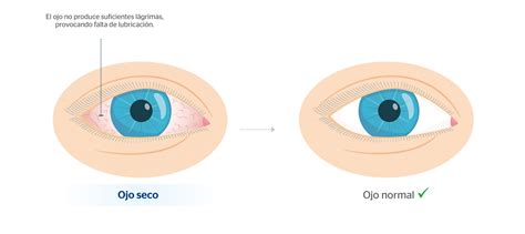 Esquema de las diferencias entre un ojo normal y un ojo con párpado caído o encapotado, resaltando el exceso de piel