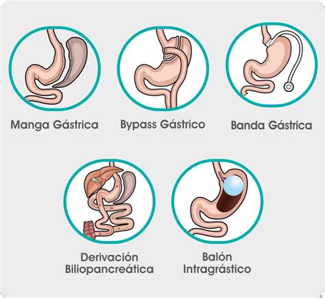 Esquema mostrando los diferentes tipos de cirugía bariátrica: bypass gástrico, manga gástrica