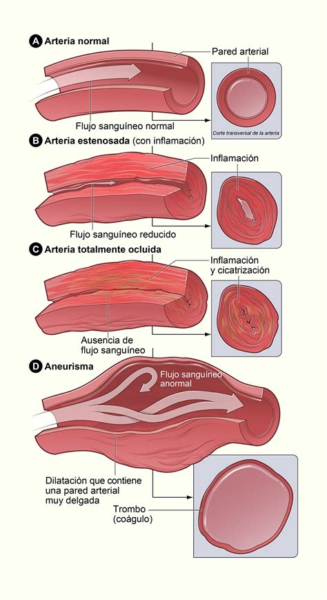 Diagrama de los cambios vasculares en arterias con la edad