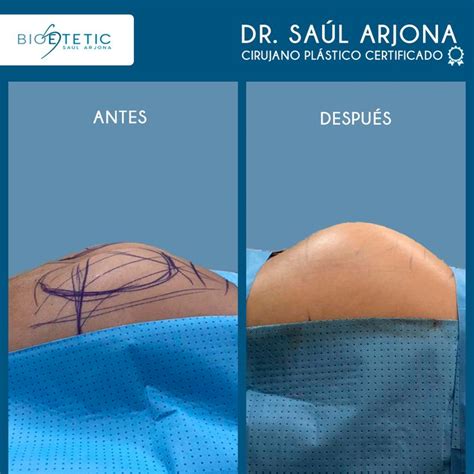 Implantes de glúteos y lipotransferencia