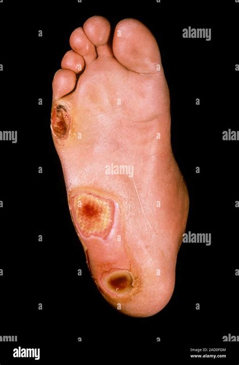 Ilustración que muestra úlceras en los pies, un síntoma avanzado de arteriopatía periférica.