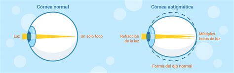 Comparación de la forma de una córnea normal (esférica) y una córnea astigmática (ovalada)