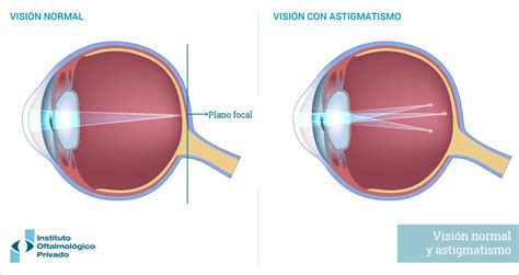 Esquema de cómo la luz se enfoca en un ojo normal versus se dispersa en un ojo con astigmatismo
