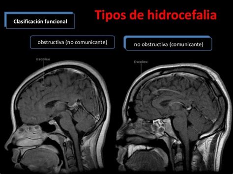Ilustración de los diferentes tipos de hidrocefalia: comunicante, no comunicante y ex-vacuo