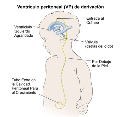 Esquema de un sistema de derivación ventriculoperitoneal
