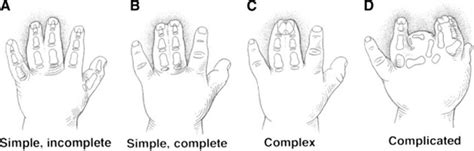 Ilustración de diferentes tipos de malformaciones congénitas de la mano (polidactilia, sindactilia, simbraquidactilia)