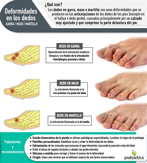 Esquema de las deformidades del dedo en martillo del pie