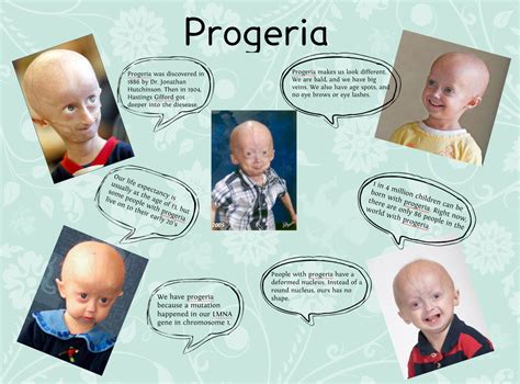 Esquema de las principales características físicas de la progeria en niños