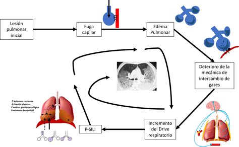 Esquema que ilustra los diferentes tipos de daño pulmonar inducido por ventilación mecánica (VILI) y su relación con el biotrauma.
