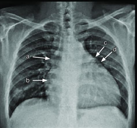 Radiografía de tórax mostrando cardiomegalia en un paciente con síndrome de Edwards
