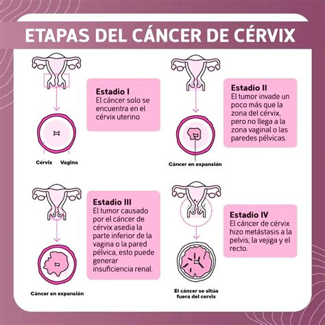 Ilustración de los diferentes estadios del cáncer vaginal