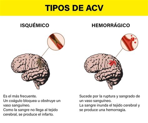 Diagrama de un ACV isquémico y hemorrágico, mostrando la obstrucción arterial y el área cerebral afectada