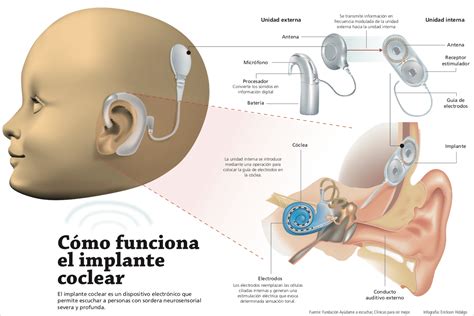 Persona utilizando audífonos o implante coclear