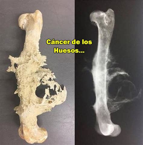 Esquema del desarrollo del osteosarcoma en un hueso largo