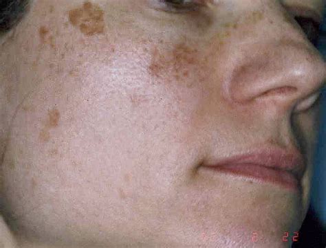 Tabla comparativa de pecas y léntigos solares