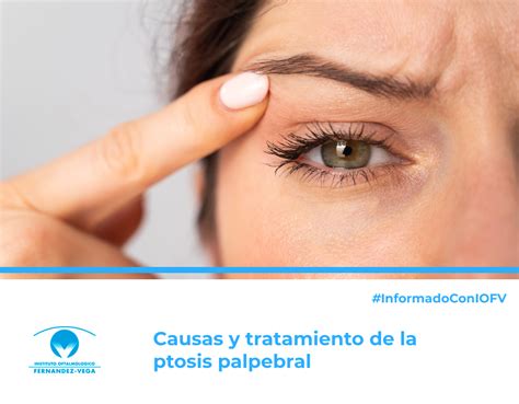 Esquema ilustrando las causas de la ptosis mamaria, incluyendo edad, genética, cambios de peso y gravedad