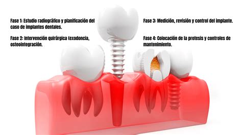 Esquema de un tratamiento dental