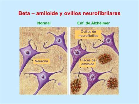 Esquema cerebral mostrando placas amiloides y ovillos neurofibrilares en Alzheimer