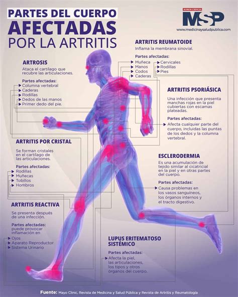 Infografía: Partes del cuerpo afectadas por TME