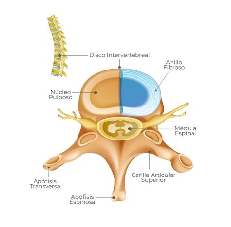 Ilustración de la columna vertebral y disco herniado