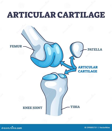 Esquema anatómico mostrando el desgaste del cartílago en una articulación de la rodilla sana frente a una con artrosis