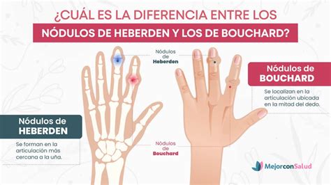 Infografía comparativa: nódulos de Heberden (articulaciones distales) y nódulos de Bouchard (articulaciones medias de los dedos)
