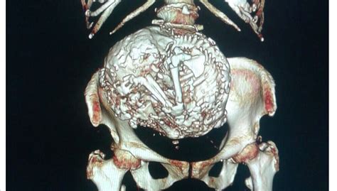 Radiografía de un feto momificado