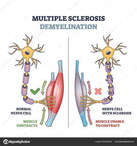 Diagrama de la desmielinización en Esclerosis Múltiple