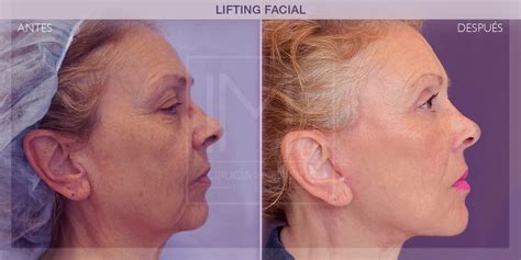 Representación de un lifting facial para rejuvenecimiento