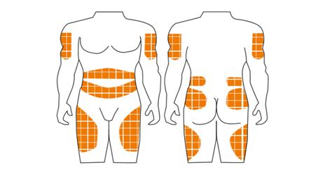 Esquema de las zonas de inyección de insulina en el cuerpo humano, mostrando las áreas de rotación
