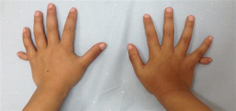 Visión palmar de la mano con polidactilia, con dificultad por limitación de extensión de muñeca.