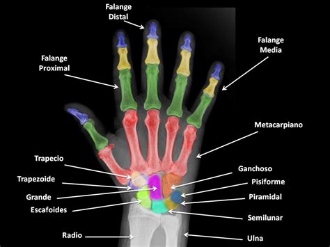 Radiografía anteroposterior de la mano con siete dedos y anomalías óseas.