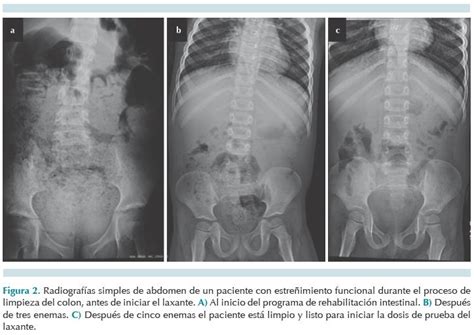 Radiografía abdominal mostrando una impactación fecal