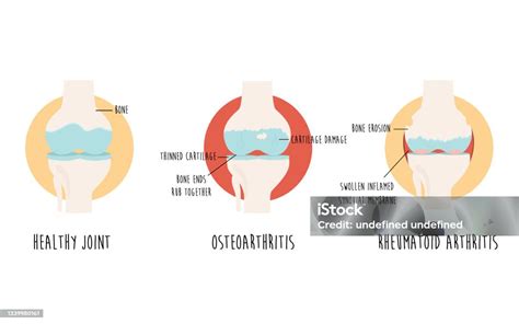 Diagrama de articulación sana vs articulación con artritis