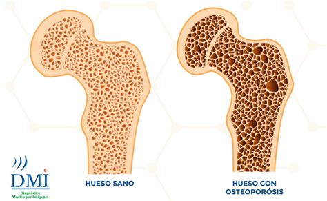 Esquema de densidad ósea comparando hueso sano y osteoporótico