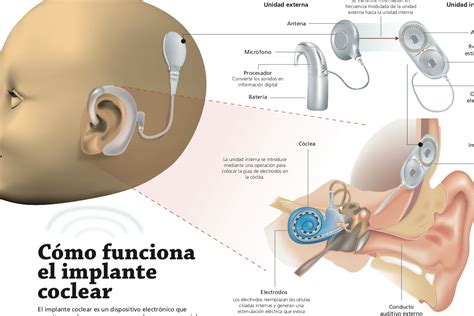 Infografía mostrando diferentes tipos de tecnologías de asistencia auditiva: audífonos, implantes cocleares, sistemas FM, subtítulos.