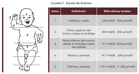 Tabla de la escala de Kramer para la valoración de ictericia