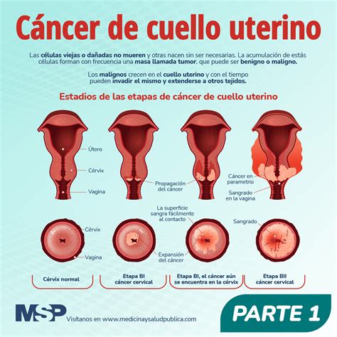 Infografía detallando los estadios del cáncer de cuello uterino