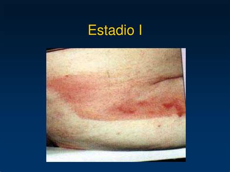 Imagen de una úlcera por presión en Estadio 1 con enrojecimiento que no palidece