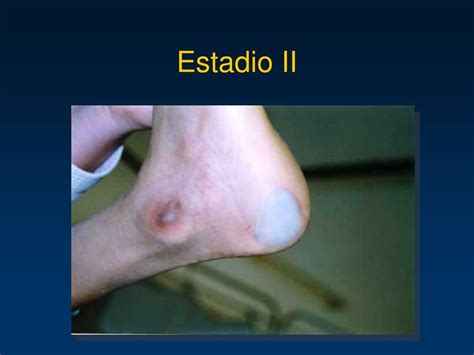 Imagen de una úlcera por presión en Estadio 2 con pérdida parcial de la piel y base eritematosa