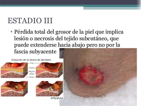 Imagen de una úlcera por presión en Estadio 3 con pérdida total del grosor de la piel sin exposición de músculo o hueso