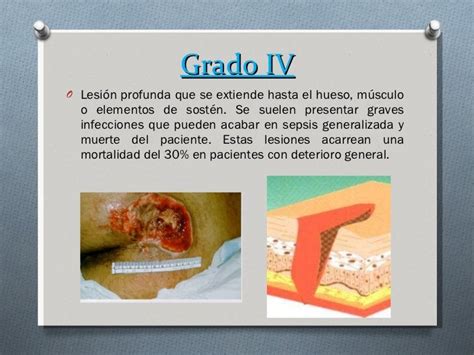 Imagen de una úlcera por presión en Estadio 4 con exposición de músculo y hueso