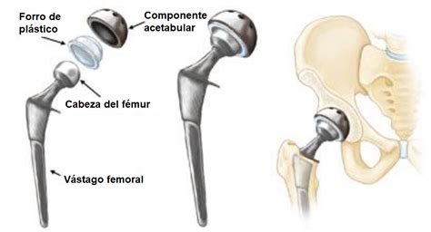 Diagrama detallado de los componentes de una prótesis total de cadera: vástago, cotilo, inserto acetabular y cabeza femoral.