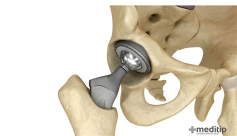 Infografía que muestra las diferentes causas comunes para un reemplazo de cadera, como la artrosis, fracturas y osteonecrosis.